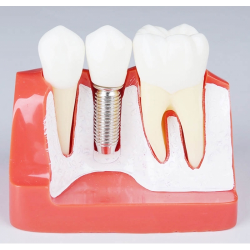 Implant Demonstration Training Model ( Red)